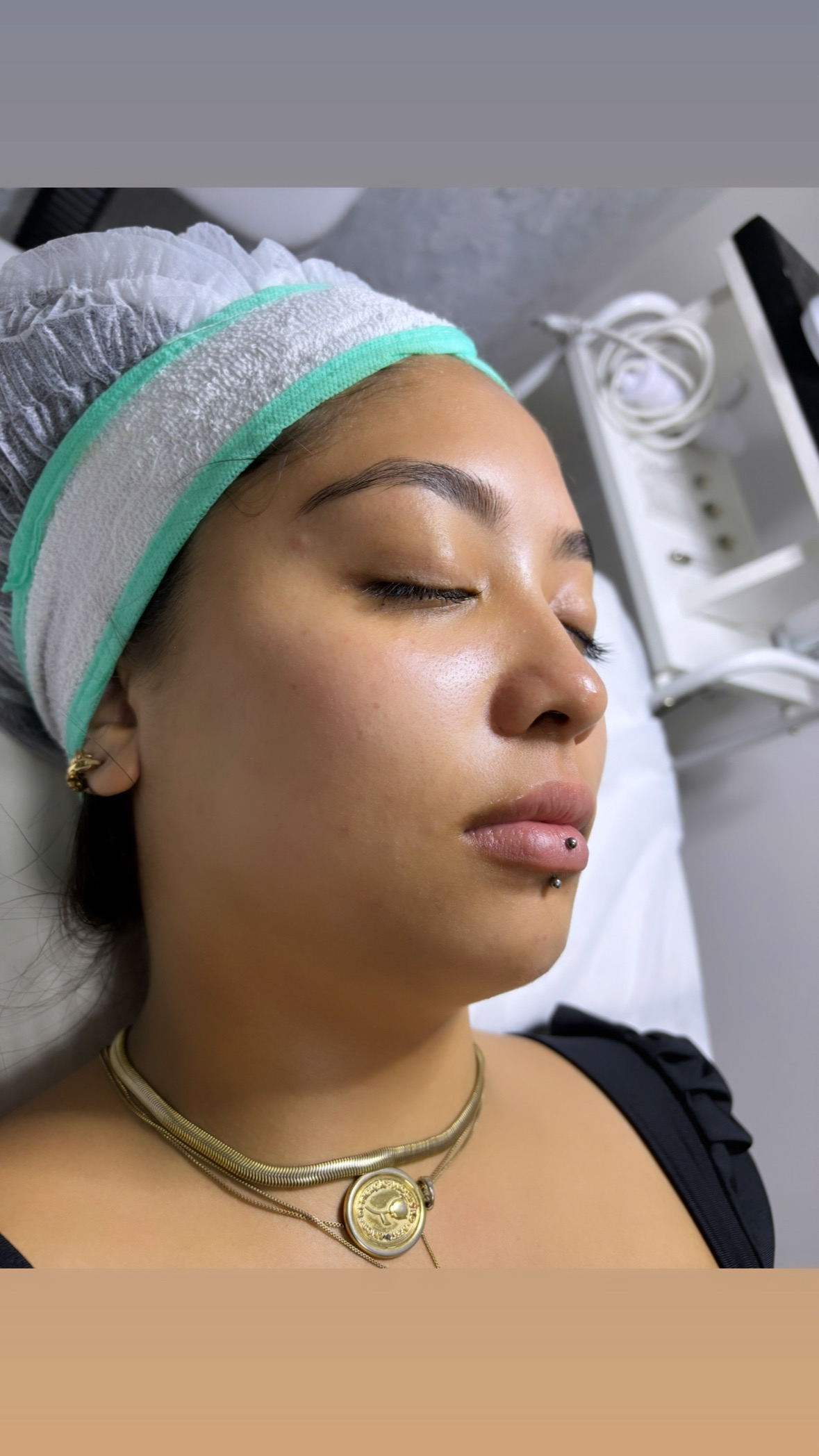 Resultado limpeza de pele